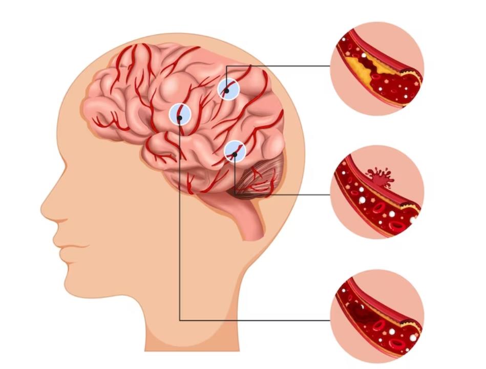 脑出血后可以造成深度昏迷吗