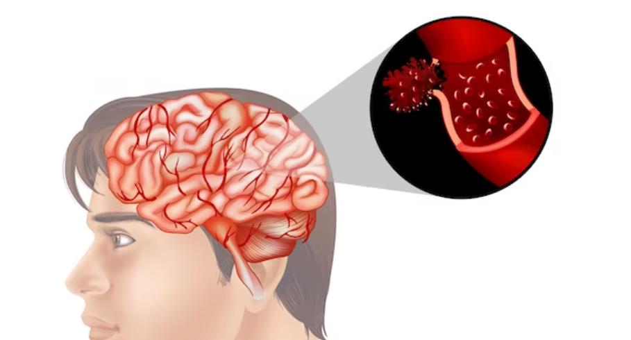 脑出血为什么会昏迷 脑出血为什么会昏迷